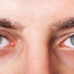 Сухість та пісок в очах: ​​що таке синдром сухого ока?
