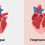 Відновлення пацієнтів із гіпертонічною хворобою