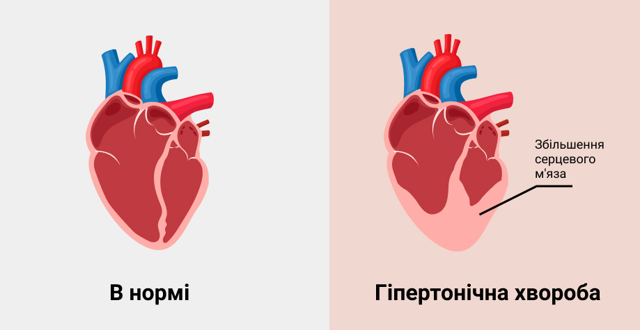 Відновлення пацієнтів із гіпертонічною хворобою