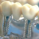 Відновлення усмішки: сучасні підходи та довготривалий результат