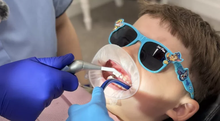 Фторування зубів у дітей: навіщо воно потрібне та коли його проводять