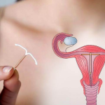 Внутрішньоматкові системи контрацепції – сучасний вибір для тривалого контролю фертильності