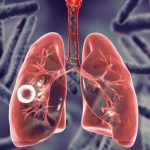 Сигнал тривоги: Одещина лідирує за рівнем туберкульозу