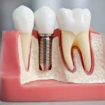 Сучасна імплантація зубів у Варшаві: як повернути впевненість у власній посмішці