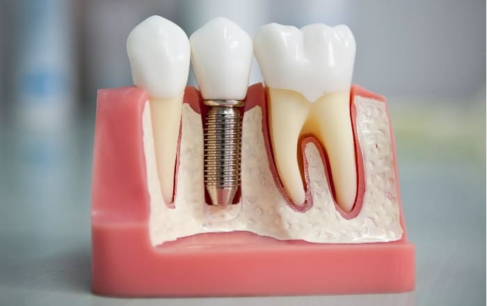 Сучасна імплантація зубів у Варшаві: як повернути впевненість у власній посмішці