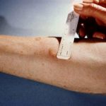 В Одесі відмовляються від Манту на користь сучасних тестів на туберкульоз