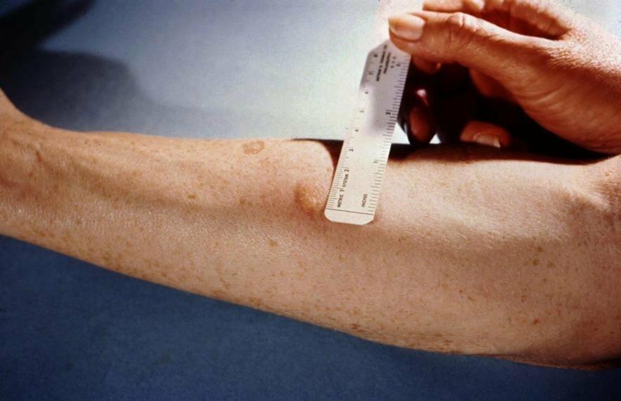 В Одесі відмовляються від Манту на користь сучасних тестів на туберкульоз