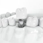 Имплантация зубов в Одессе — восстановление улыбки современными методами