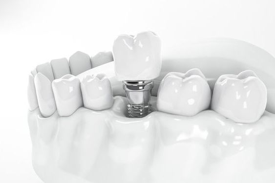Имплантация зубов в Одессе — восстановление улыбки современными методами