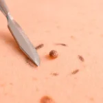 Зміна родимок: коли слід бити на сполох