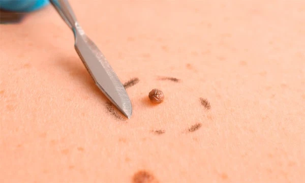 Зміна родимок: коли слід бити на сполох