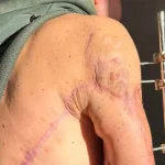 В Одесі медики зберегли руку пораненому українському військовому, уникнувши ампутації